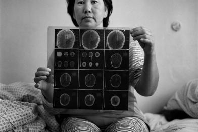 Dzunuzova Gulsum (43)  hält einen Scan in der Hand, der den Tumor in ihrem Gehirn offenbart. 