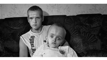 Zwillingsbrüder aus Minsk, Opfer von Tschernobyl, August 2005