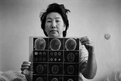 April 1999: Dsunusowa Gulsum (43) leidet an einem Gehirntumor. Sie lebt im Atombombentestgebiet.